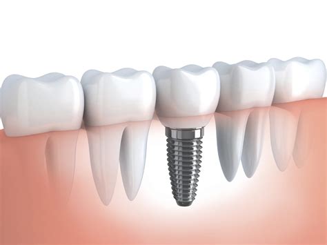 implante dental - puente fijo dental